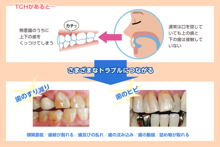 TCHがあると…　無意識のうちに上下の歯をくっつけてしまう　通常は口を閉じていても上の歯と下の歯は接触していない→さまざまなトラブルにつながる　歯のすり減り　歯のヒビ　顎関節症/歯根が割れる/歯並びの乱れ/歯の沈み込み/歯の動揺/詰め物が取れる